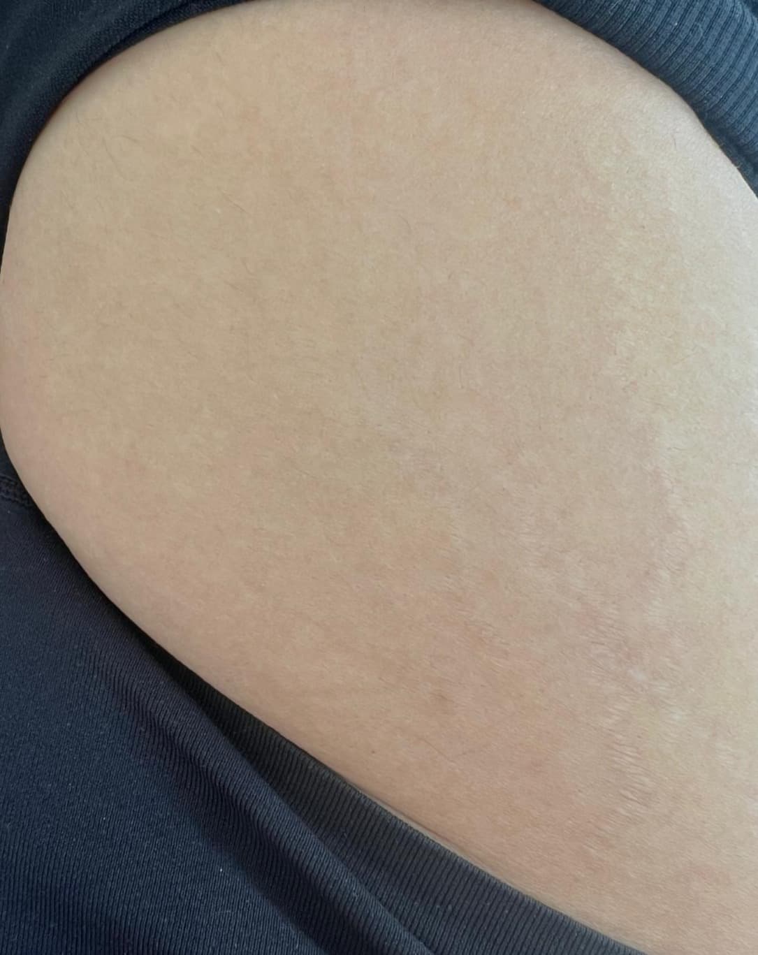 Tratamento de Estrias — Depois